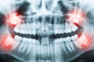 x ray image of impacted wisdom teeth