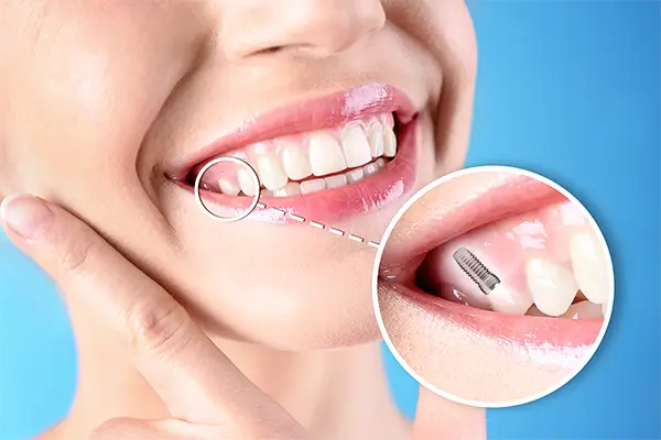dental implant candidate 2
