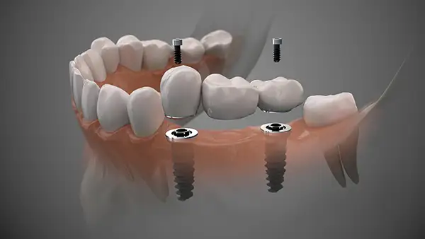 implant bridge 2