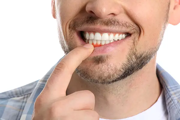 periodontal disease symptoms 2