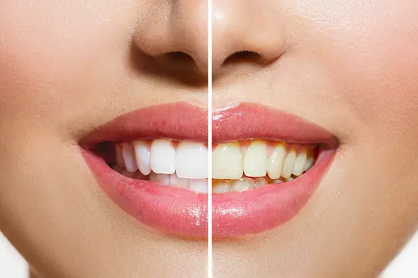 teeth whitening 4